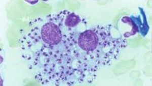 Myelom